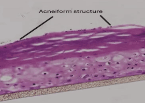 Acne Skin Model (BioDAcne) histology