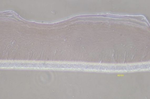 BioDdand  - Pigmented Melanoma