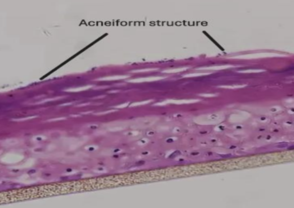Acne-Induced Skin model render